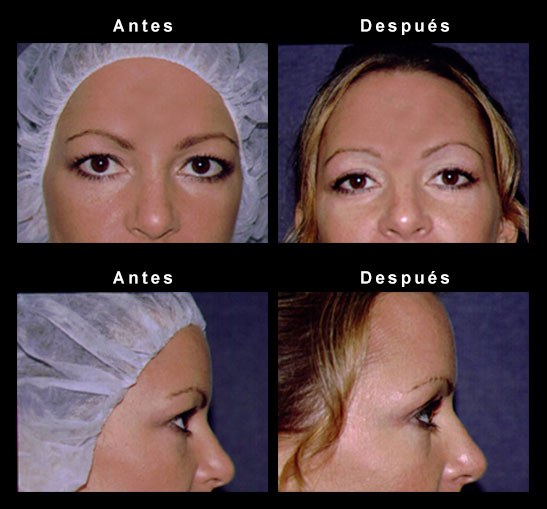 Upper Eyelid Surgery - Chicago-IL