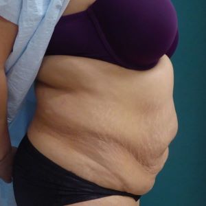 abdominoplastia case 8