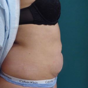 abdominoplastia case 9