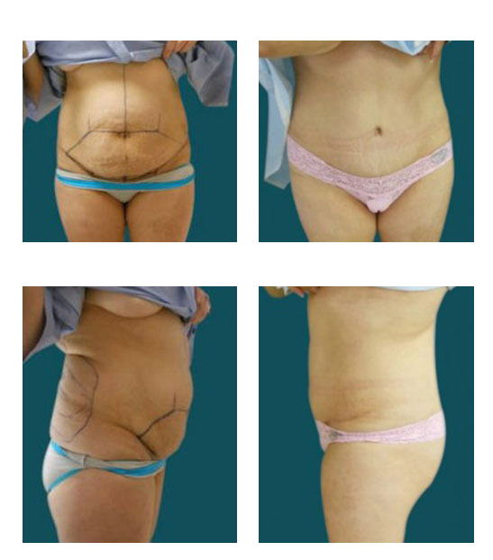 abdominoplastia case 13