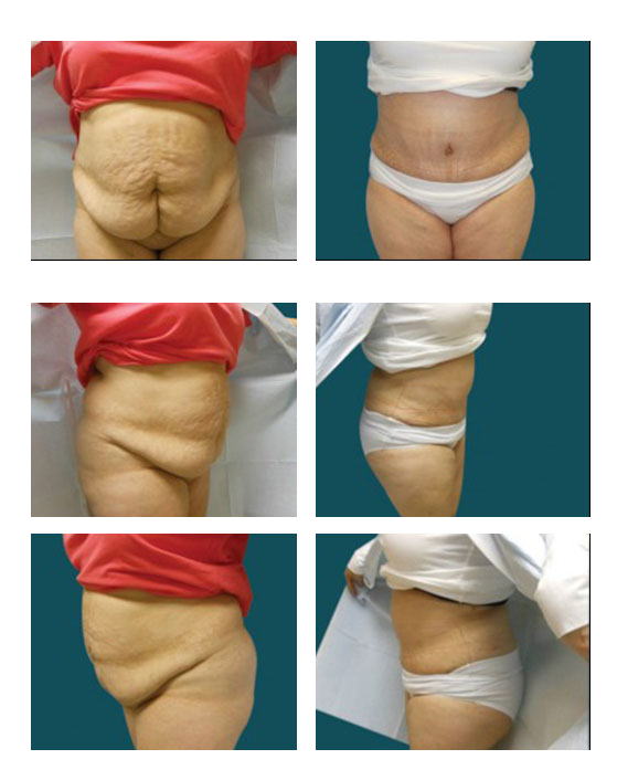 abdominoplastia case 21