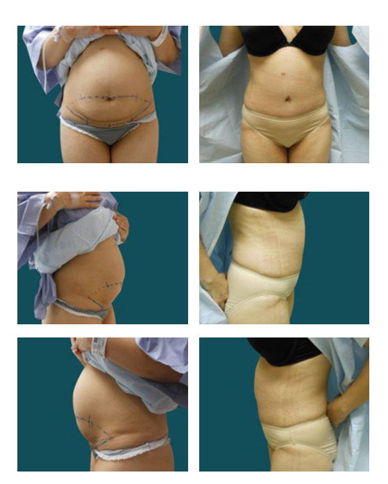 abdominoplastia case 22