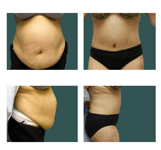 abdominoplastia case 15