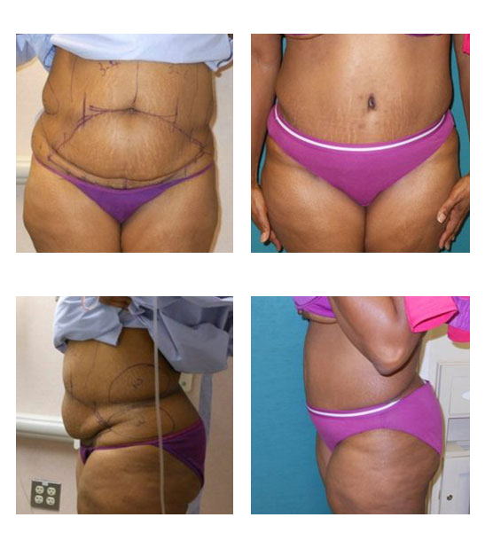 abdominoplastia case 23