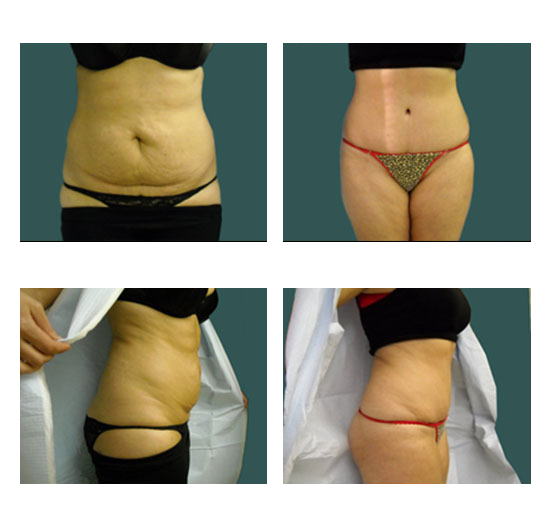 abdominoplastia case 14