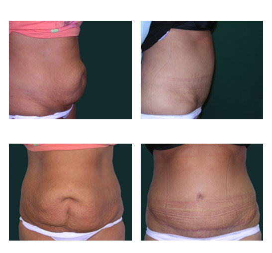 abdominoplastia case 25