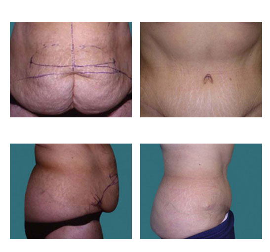 abdominoplastia case 26