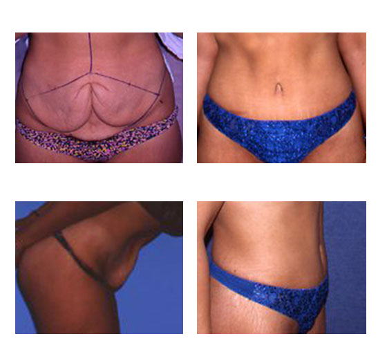 abdominoplastia case 27