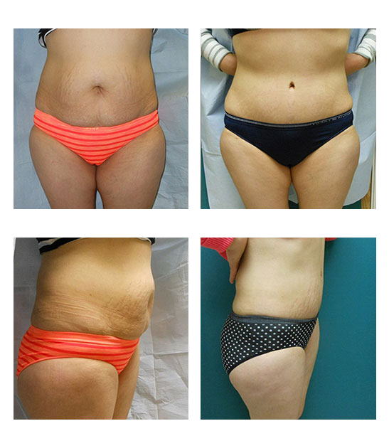 abdominoplastia case 18