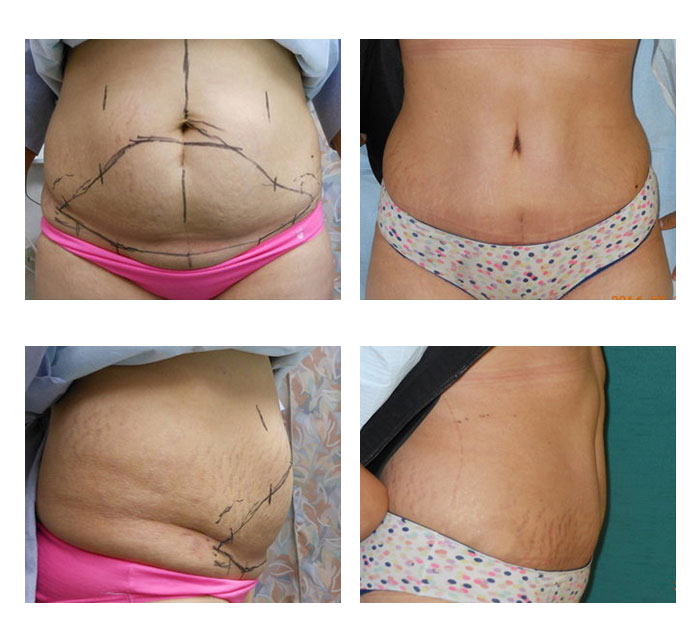 abdominoplastia case 19