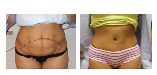 abdominoplastia case 20