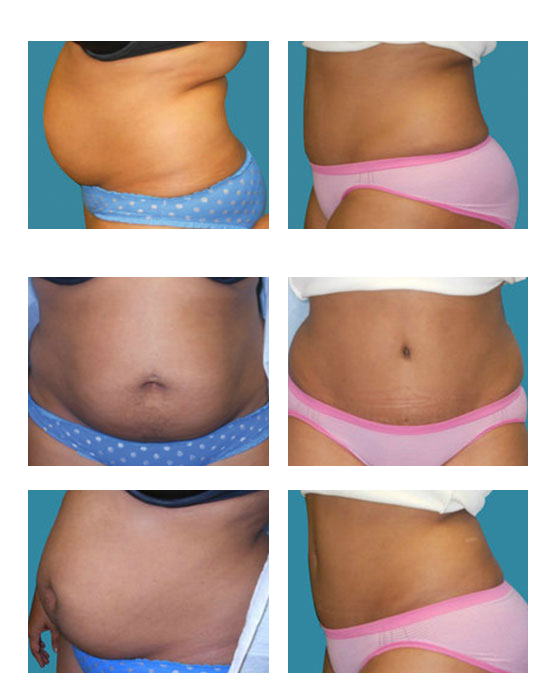 abdominoplastia case 12