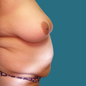 Imagen de antes del Mommy Makeover, cirugía de aumento de senos y abdominoplastia, caso 9