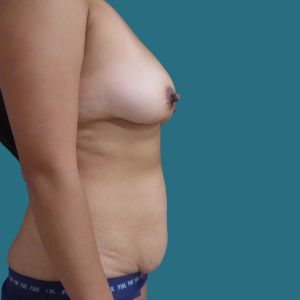 Imagen de antes del Mommy Makeover, cirugía de aumento de senos y abdominoplastia, caso 2