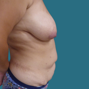 Imagen de antes del Mommy Makeover, cirugía de aumento de senos y abdominoplastia, caso 1