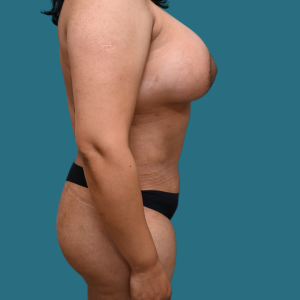 Imagen de despues del Mommy Makeover, cirugía de aumento de senos y abdominoplastia, caso 3