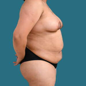 Imagen de antes del Mommy Makeover, cirugía de aumento de senos y abdominoplastia, caso 3