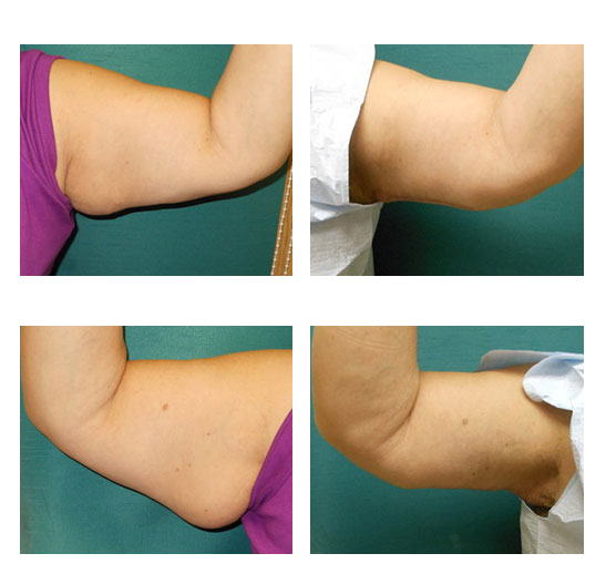 Imagen antes y después de braquioplastia, reducción de piel en brazos, caso 10, comparación en collage