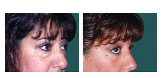 Imagen antes y después de blefaroplastia, cirugía estética de párpados, caso 7, comparación en collage