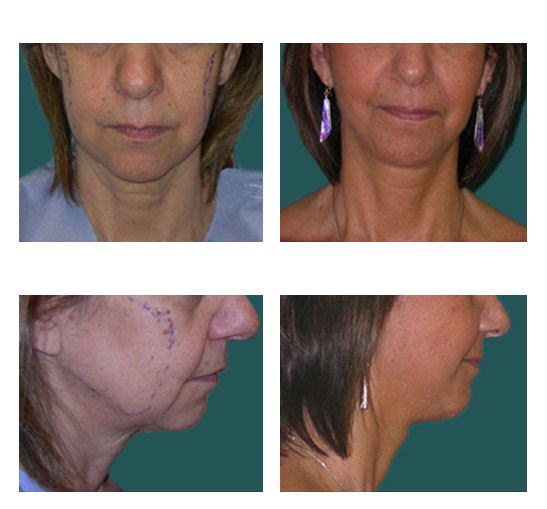 Imagen antes y después de blefaroplastia, cirugía estética de párpados, caso 10, comparación en collage