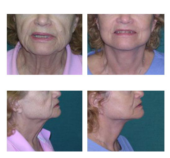 Imagen antes y después de blefaroplastia, cirugía estética de párpados, caso 7, comparación en collage