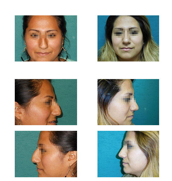 Imagen antes y después de rinoplastia, cirugía estética de nariz, caso 5, comparación en collage