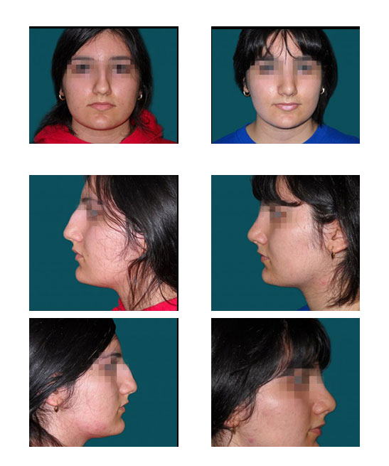 Imagen antes y después de rinoplastia, cirugía estética de nariz, caso 11, comparación en collage