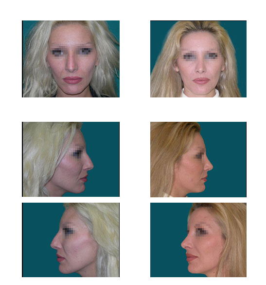 Imagen antes y después de rinoplastia, cirugía estética de nariz, caso 6, comparación en collage