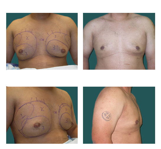 Imagen antes y después de reducción mamaria para hombres, caso 11, cirugía de ginecomastia, comparación en collage